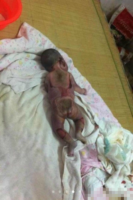 新生婴儿被保温箱烤死续:医院推卸责任